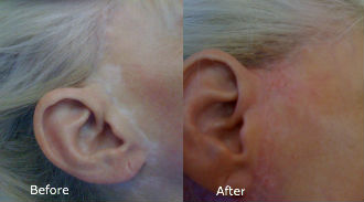 BCI scar cover with micropigmentation