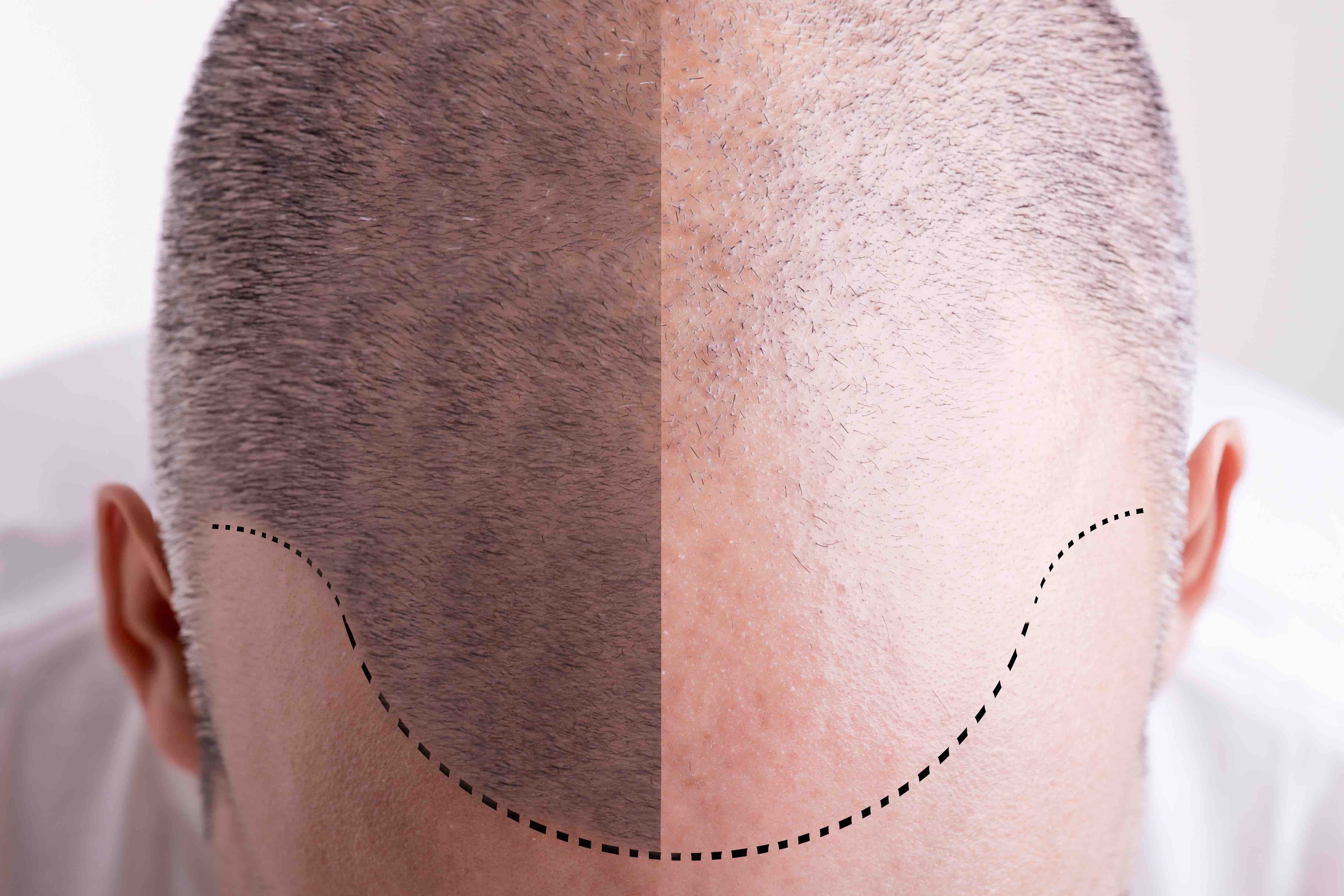 Aesthetic Medicine - BAHRS partners with CQC to create an inspection guide to promote safety for patients undergoing hair restoration Aesthetic Medicine - BAHRS partners with CQC to create an inspection guide to promote safety for patients undergoing hair restoration