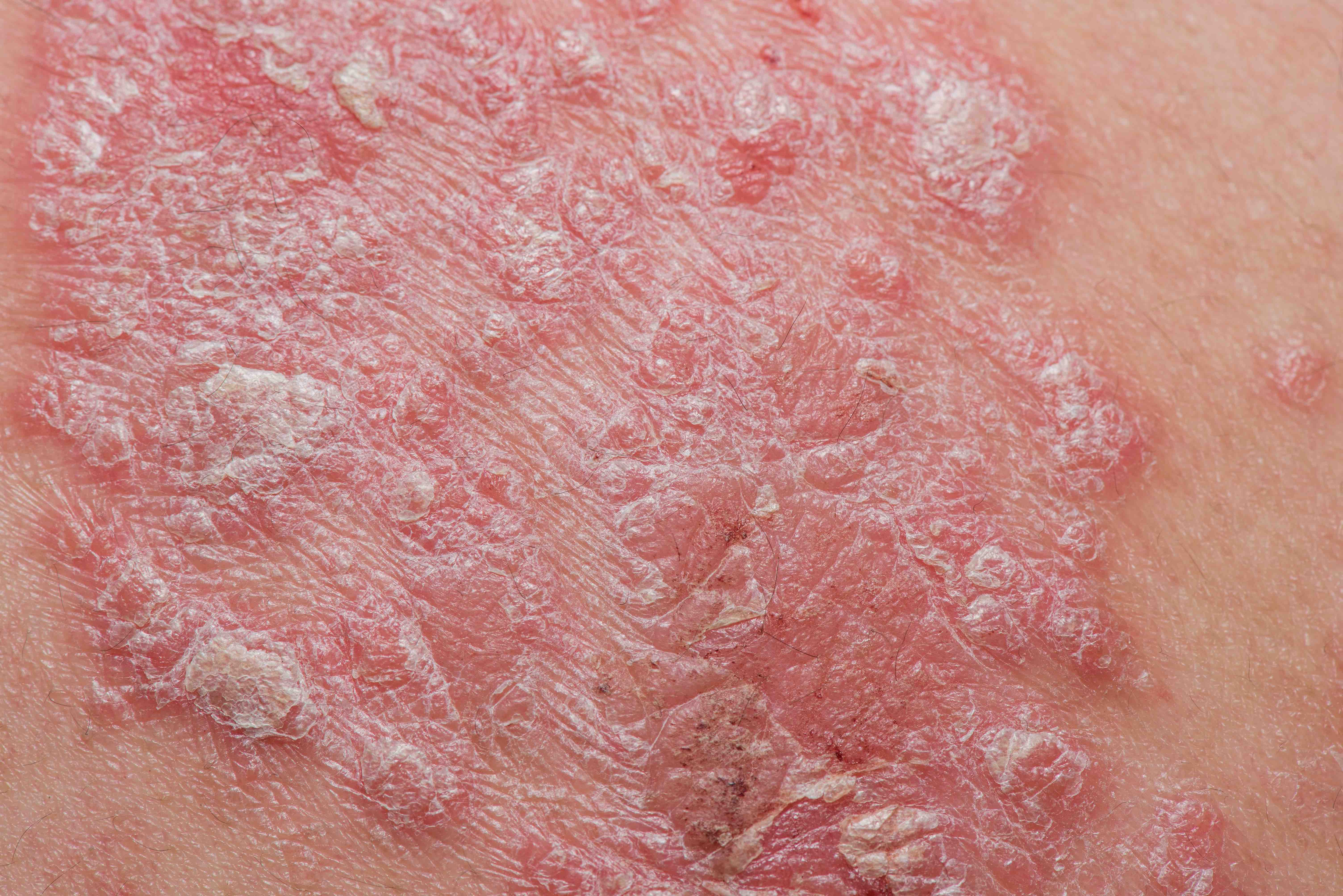 Aesthetic Medicine - The European Commission (EC) approves Almirall’s ...
