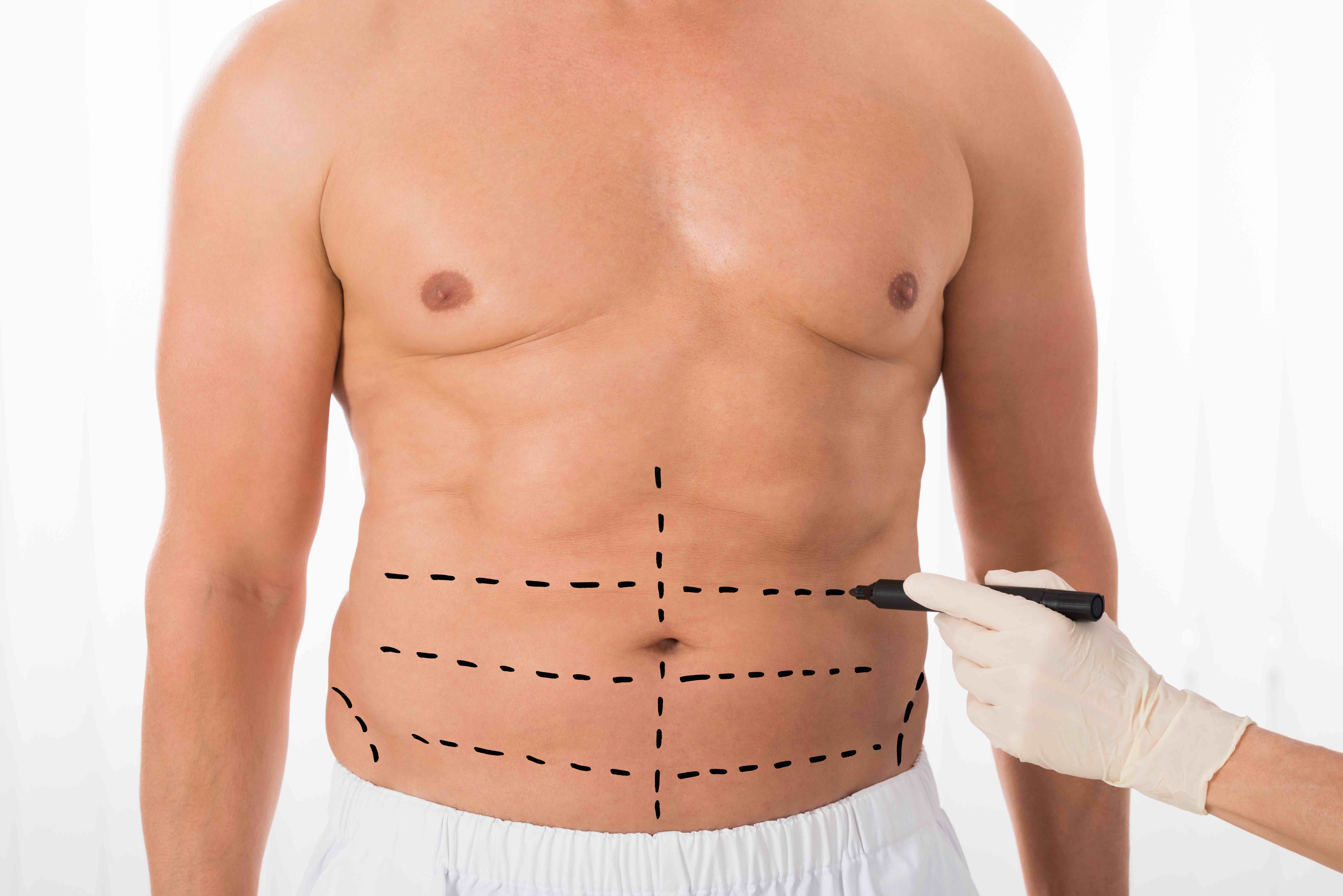 Male Body Contouring Sees Rise in Popularity - AHB