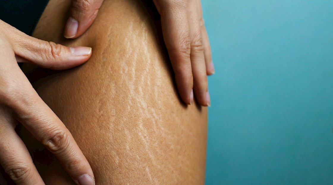 Tanning scars and stretch marks