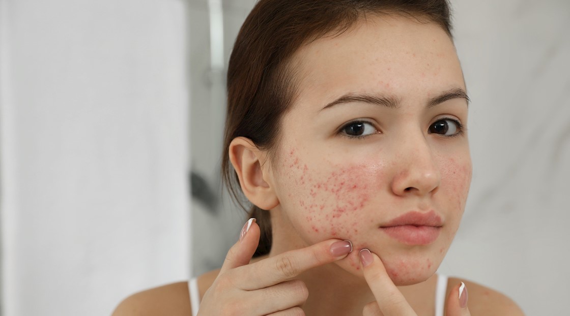 Omega 3 could be key to acne treatment