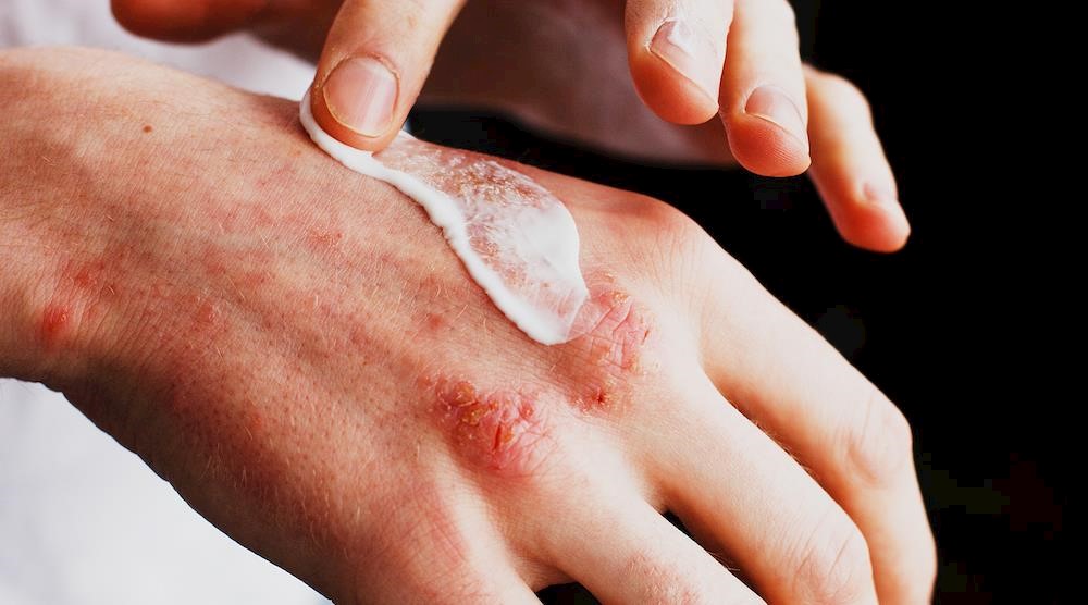 New campaign raises awareness of topical steroid withdrawal