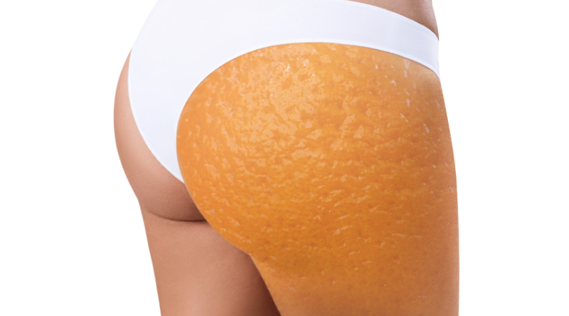 A majority of women have cellulite. - Olympic Dermatology & Laser