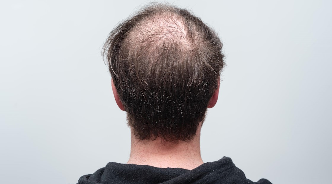 LISTEN Hair loss in men might occur from as young as 20 years old