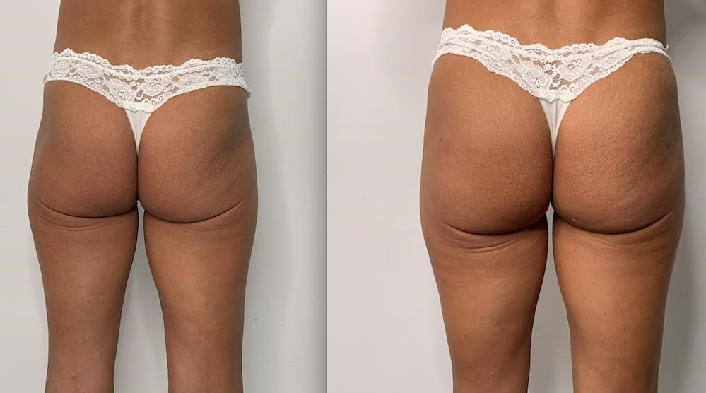 Before and after image of buttock enhancement