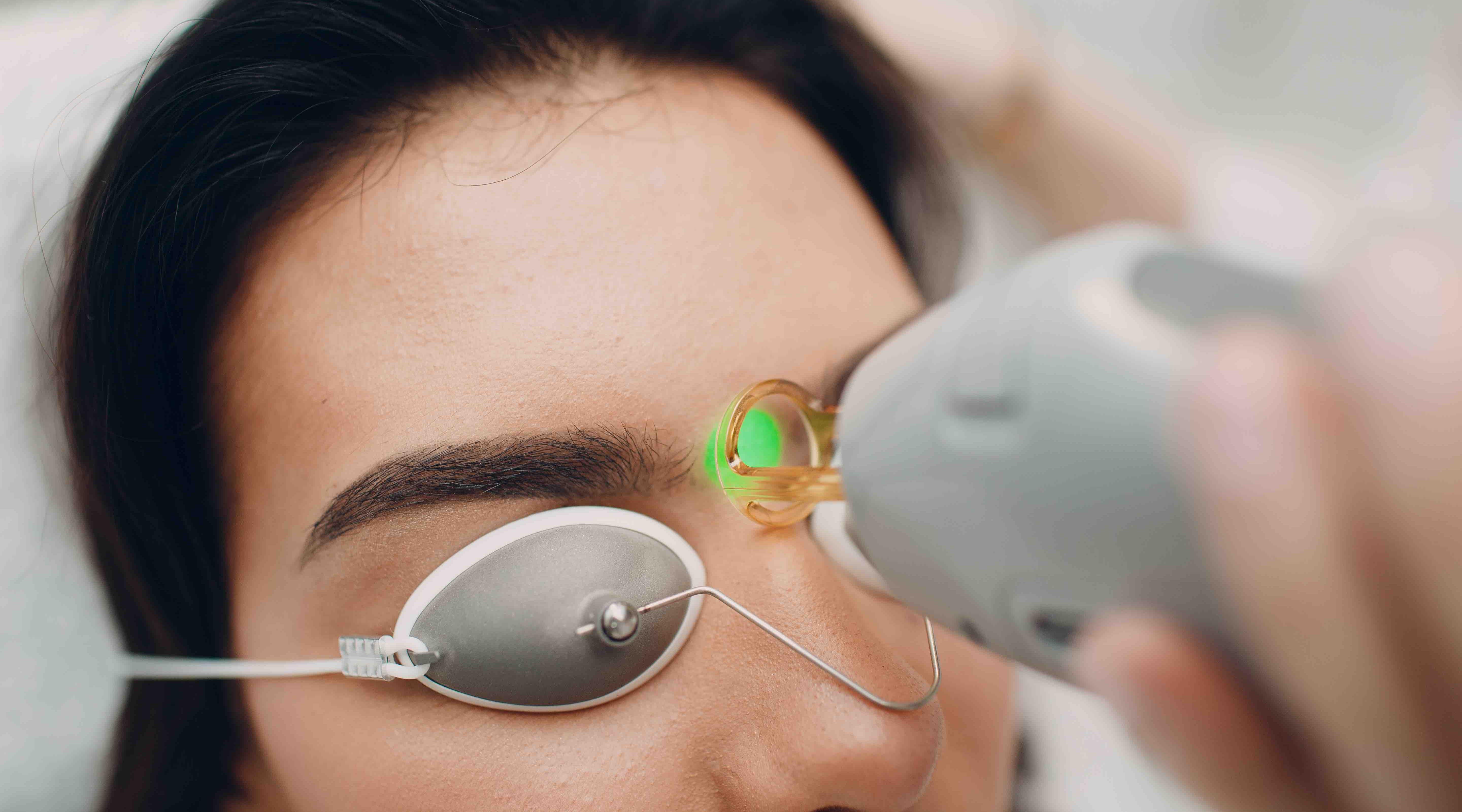 Best laser for microblading removal