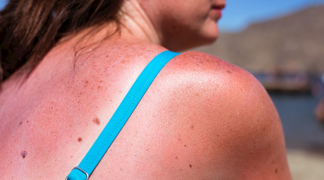 Worrying lack of sunsafety knowledge in US