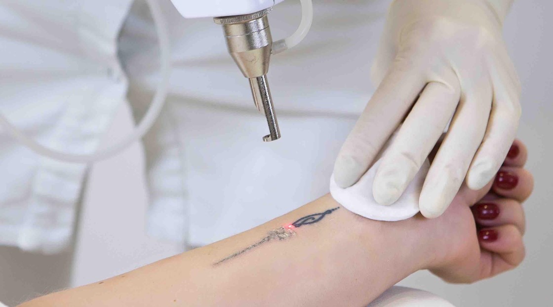 Laser Tattoo Removal Leamington Spa, Coventry | Skinthetics