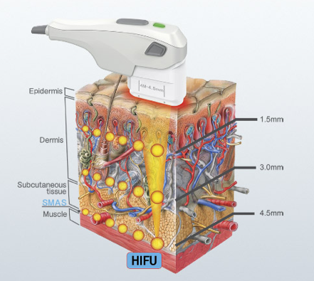 Combining HIFU and Silhouette Soft for lifting and tightening