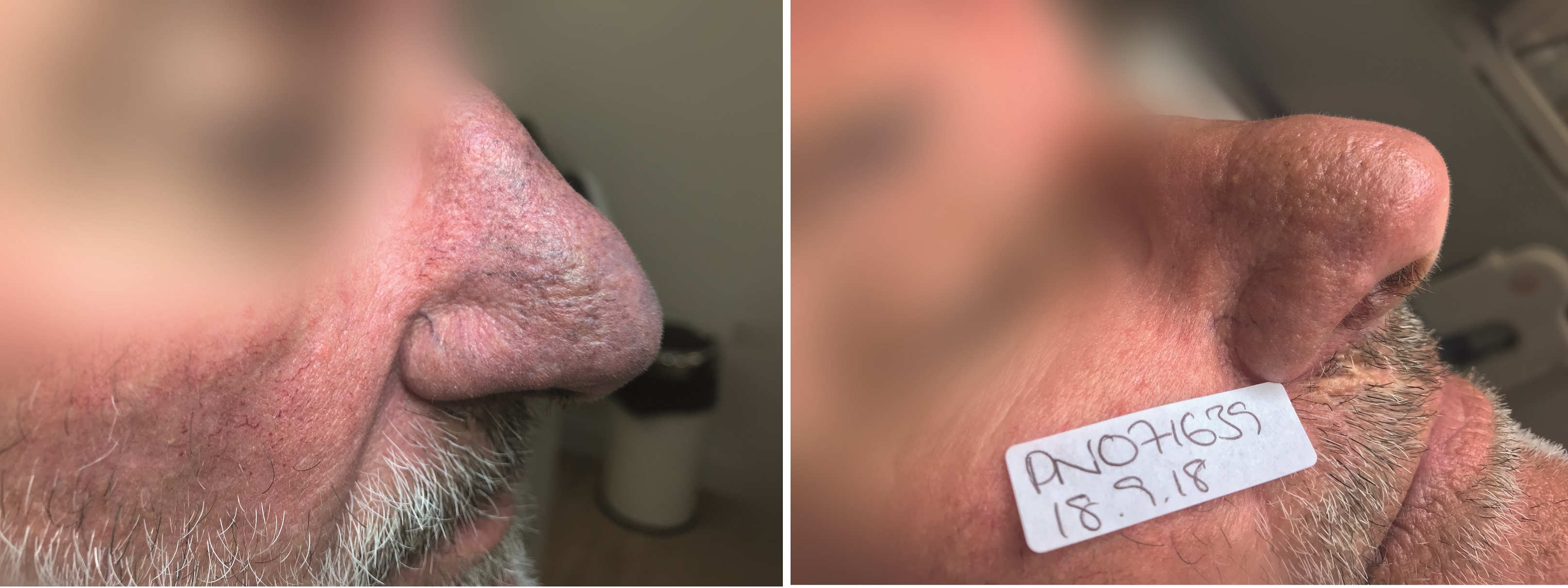 melanotan rosacea Best Ways to Treat Rosacea & Reduce Redness Canton MI main image 0